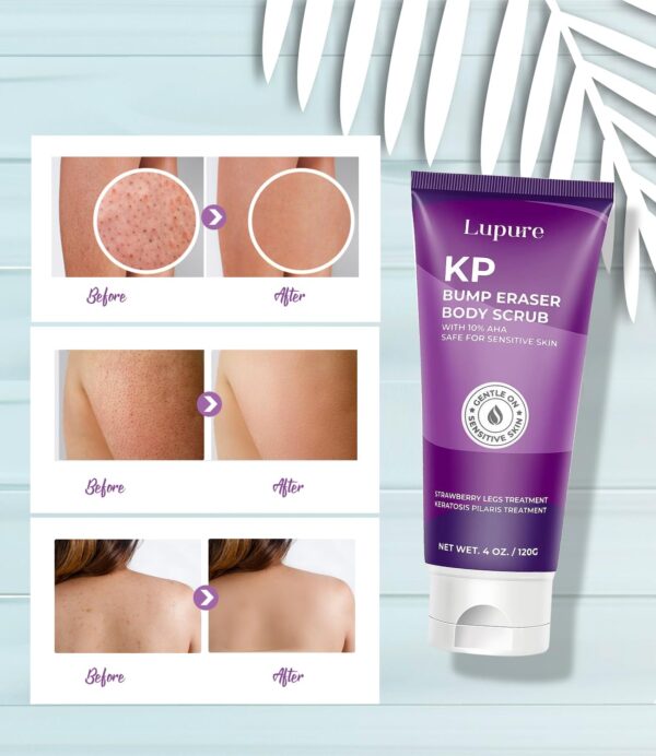 KP Bump Eraser Body Scrub : Lupure Upgraded KP Bump Eraser Body exfoliator for Strawberry and Chicken Skin Treatment with 10% Lactic Acid (AHA) - 4 Oz - Image 3