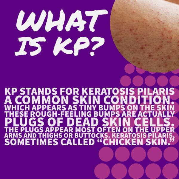 KP Keratosis Pilaris Treatment, KP Bump Eraser Hydrating lotion, Bumps Be Gone, Moisturizing and exfoliating lotion For Rough and Bumpy Dry Skin For Body, 8 Oz - Image 3