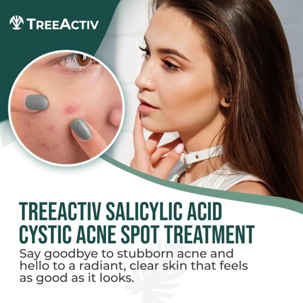 TreeActiv Salicylic Acid Cystic Acne Spot Treatment, 0.5 fl oz, Acne Treatment for Face, Acne Spot Cream, Hormonal Acne Treatment, Acne Spot Treatment for Face and Body, Acne Cream for Teens & Adults - Image 2